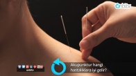 Akupunktur hangi hastalıklara iyi gelir?