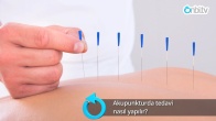 Akupunkturda tedavi nasıl yapılır?