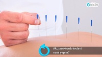 Akupunkturda tedavi nasıl yapılır?
