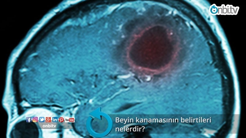 Beyin kanamasının belirtileri nelerdir? 